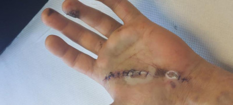 Buenos días.
El día 3 tuve un accidente con un rifle.
El arma era un Mannlicher M72 en calibre 270w.
Llegado 10
